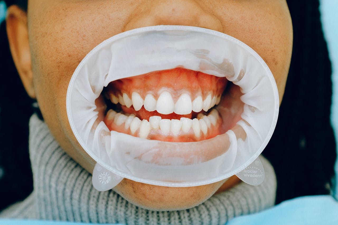 عيادة رويال لطب الاسنان - كيفية زراعة السن - مركز رويال سمايل الطبي - How To Implant A Tooth Safely - Royal Smile Medical Center