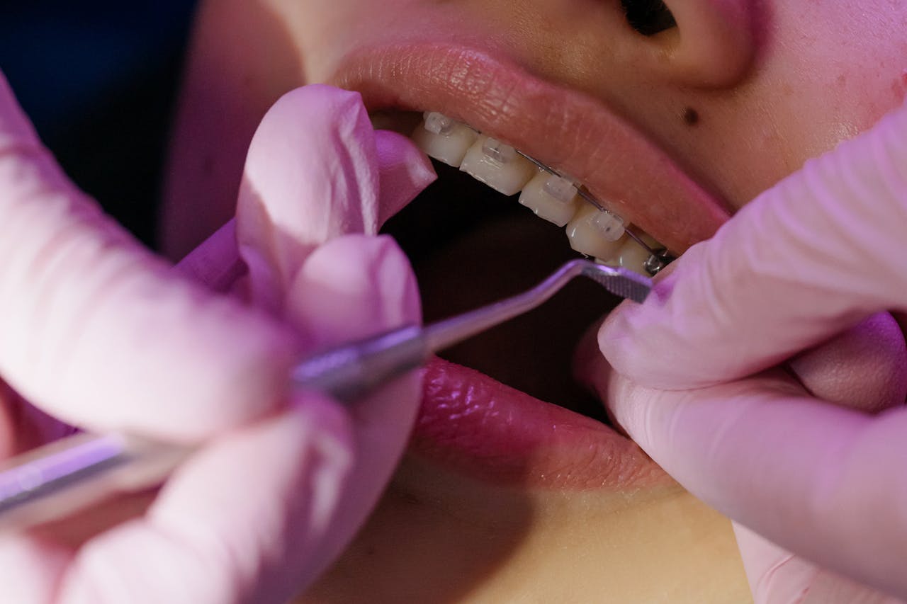 طب الأسنان - افضل طريقة لتجميل الاسنان - مركز رويال سمايل الطبي - Teeth whitening solutions - Royal Smile Medical Center
