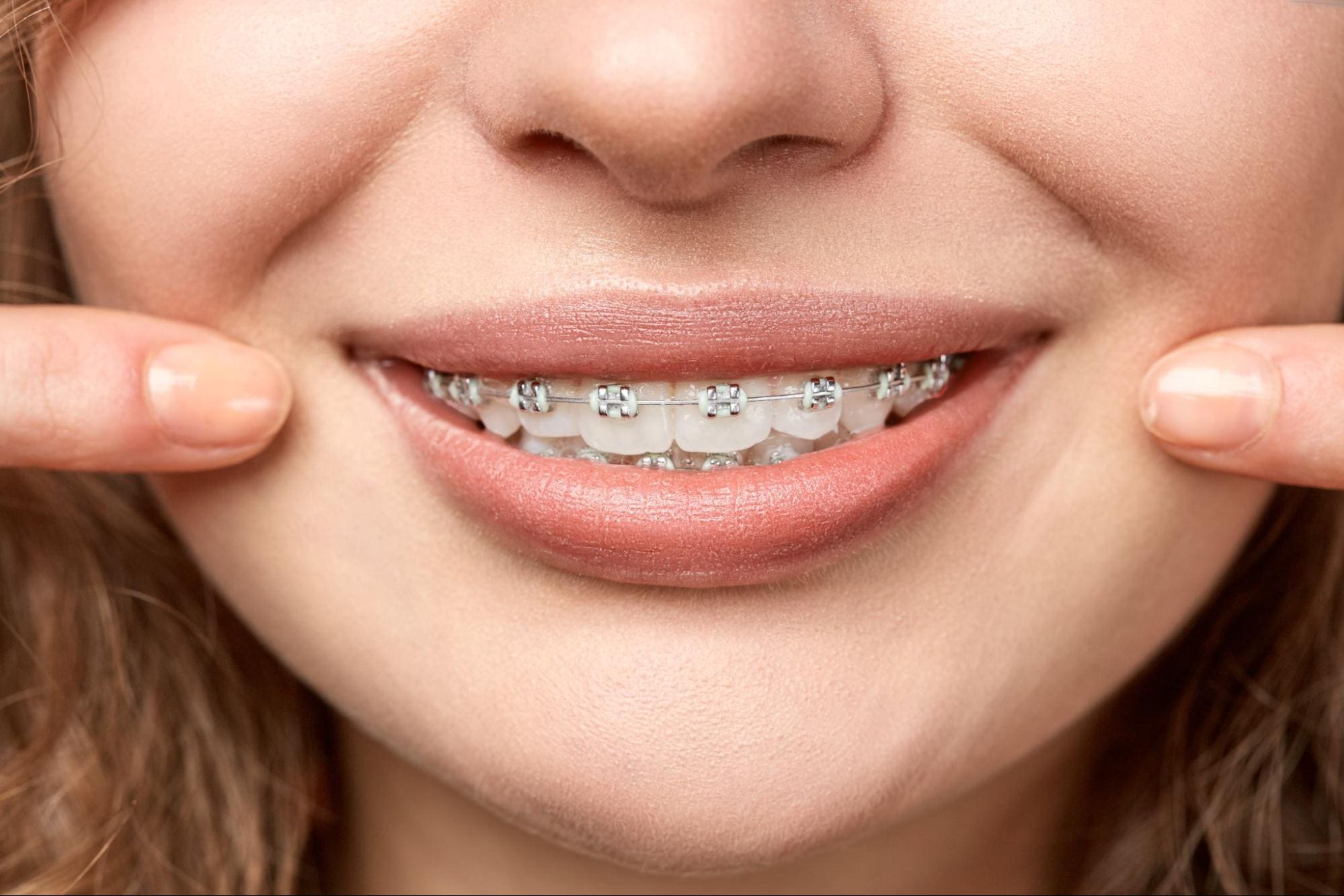 افضل انواع التقويم الاسنان - مركز رويال سمايل الطبي - Types of braces - Royal Smile Medical Center